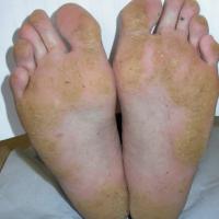 
	Punctate and focal keratoderma (inherited) 
