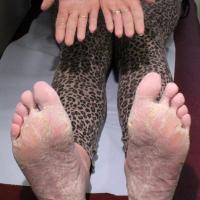 
	Diffuse keratoderma (inherited)