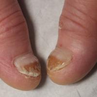 
	As previous image

	The nail thickening had…