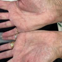 Punctate keratoderma