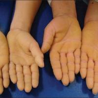 
	Non-epidermolytic keratoderma (Thost-Unna…
