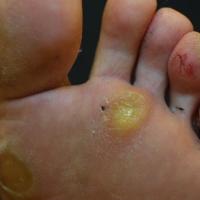 
	Painful callosities