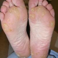 
	Punctate keratoderma (inherited)