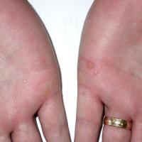 
	Same patient as previous figure