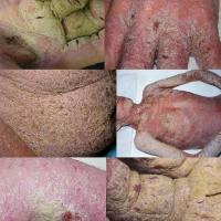 
	Crusted scabies