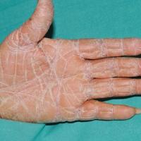 
	Keratoderma secondary to pityriasis rubra…