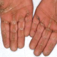 
	Striate keratoderma