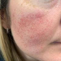 Atrophoderma vermiculatam