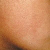 
	Erythromelanosis follicularis faciei et colli