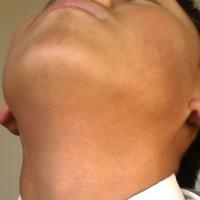 
	Erythromelanosis follicularis faciei et colli