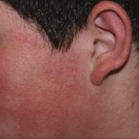 
	Keratosis rubra pilaris faciei atrophicans