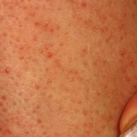 
	Keratosis pilaris