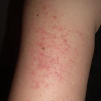 
	Keratosis pilaris

	Significant perifollicular…