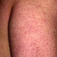 
	Keratosis pilaris