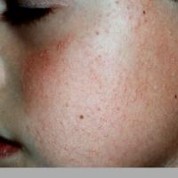 
	Keratosis pilaris