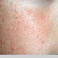 
	Keratosis pilaris