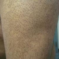 
	Keratosis pilaris on the thighs