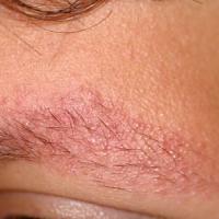 
	Keratosis rubra pilaris faciei atrophicans