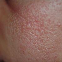 
	Atrophoderma vermiculatam