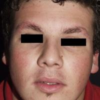 
	Keratosis rubra pilaris faciei…