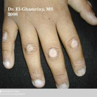 
	Knuckle pads