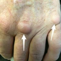 
	Knuckle pads secondary to trauma&nbsp;