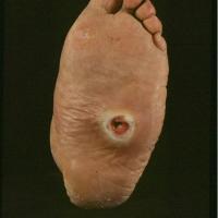 
	Neuropathic ulcer on a diabetic foot

	The…