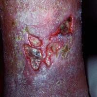 
	Venous leg ulcer