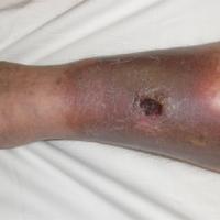 
	Lipodermatosclerosis and venous leg ulcer