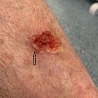 A leg ulcer that is a squamous cell…