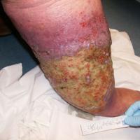 
	Venous ulcer and lymphoedema 