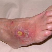 
	Arterial ulcer