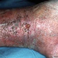 
	Early venous leg ulcer (arrow)

	Associated…