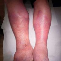Lipodermatosclerosis and venous ulcer
Copied…