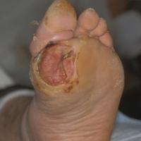 
	Large neuropathic ulcer