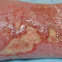 
	Venous leg ulcer: close-up
	
	Copied with kind…