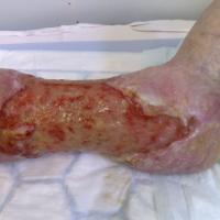 
	Extensive venous ulceration