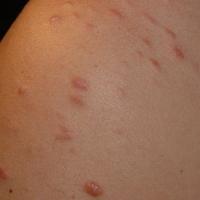 
	Piloleiomyoma - multiple lesions 

	Copied with…