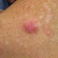 
	Dermal leiomyosarcoma