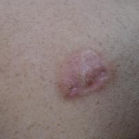 
	Dermal leiomyosarcoma

	An ill-defined nodule