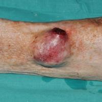 
	Subcutaneous leiomyosarcoma

	Copied with kind…