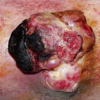
	Subcutaneous leiomyosarcoma

	Copied with kind…