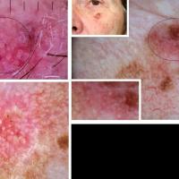 Facial erythema - comparisonBoth lesions on the…