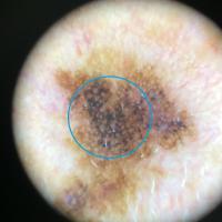 Dermoscopic appearance of previous…