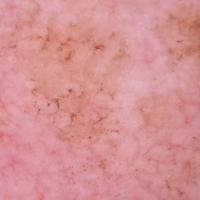 Dermoscopic image of previous…