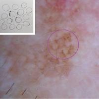 Early lentigo maligna&nbsp;Irregular dots /…