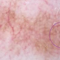 Lentigo maligna&nbsp;A subtle annular-granular…