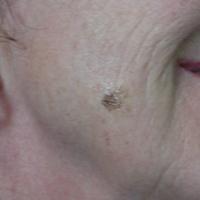 
	Lentigo maligna on the right cheek