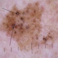 Dermoscopic appearance of previous…