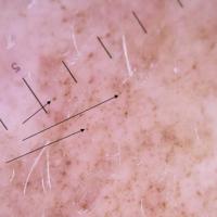 Dermoscopic appearance of previous…